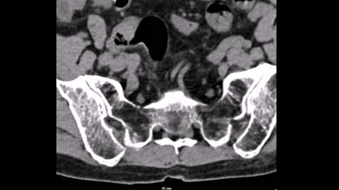 Lumbar spine 1,5mm Computed Tomography 库存影片 196876703