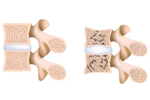 Lumbar spine osteoporosis Stock Illustration
