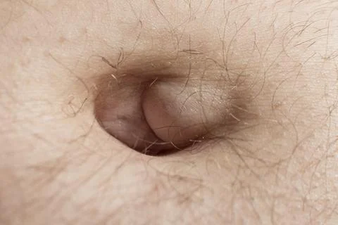 Lump in Belly Button - hernia, an inflammatory condition - possible cancer Stock Photos