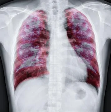 Lung 3D rendering image. Stock Illustration