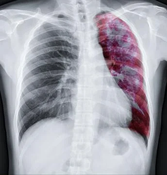 Lung 3D rendering image. Stock Illustration