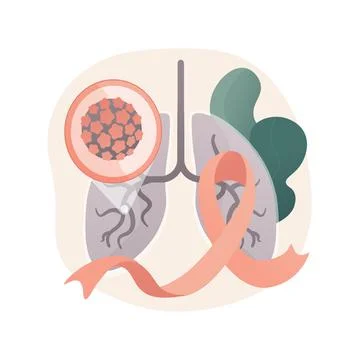 Lung cancer abstract concept vector illustration. Stock Illustration