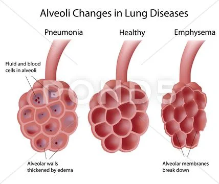 Lung diseases Stock Illustration