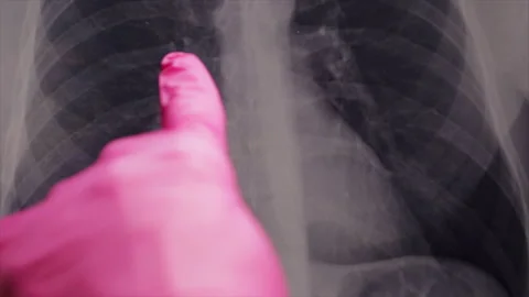 Lung node chest x-ray lung spot cancer screening. Doctor viewing chest x-ray and Видео 148396571