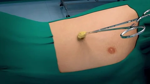Lung tumor resection surgery: intubation and mechanical ventilation Stock Footage 345199788