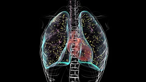 Lungs affected by miliary tuberculosis, animation Stock Footage 295178607