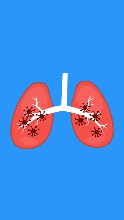 Lungs cancer Stock Footage 296290552