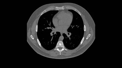 Lungs CT Scan Computed Tomography of the Male Chest. Stock Footage 131117688