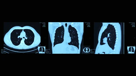 Lungs Ct Scan Stock Footage 152183593