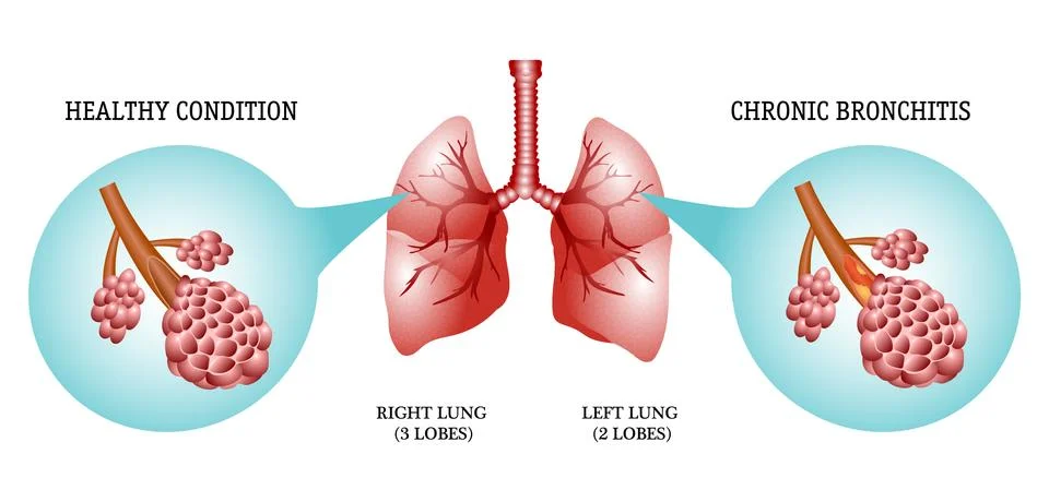 Lungs, the disease is bronchitis Stock Illustration