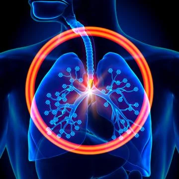 Lungs Foreign Object - inhaled or swallowed Stock Illustration