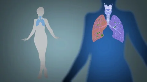 Lungs   Infection   Vector Animation   blue Stock Footage 73256071