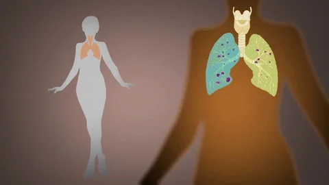 Lungs   Infection   Vector Animation   orange Stock Footage 73256072
