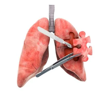 Lungs surgery concept, 3D rendering Illustrazione stock