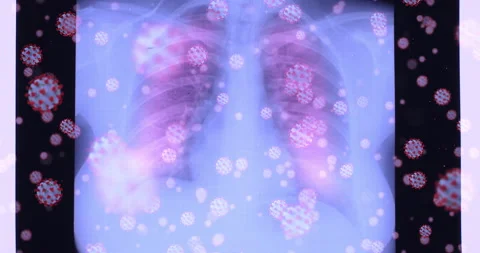 Lungs x-ray affected by coronavirus Stock Footage 148272793