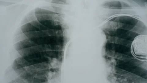 Lungs x-ray close-up. Doctor looking at ribs roentgen, human chest with cardiac Vídeo Stock 169197038