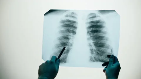 Lungs x-ray close-up. Doctor looking at ribs roentgen, human chest. Healthcare Vídeo Stock 169198735