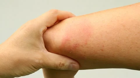 Lyme disease after a bite of a tick Stock Footage