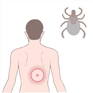 Lyme disease Stock Illustration