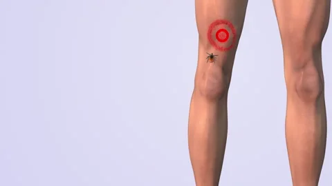 Lyme thigh red cells animation Stock Footage 270056827