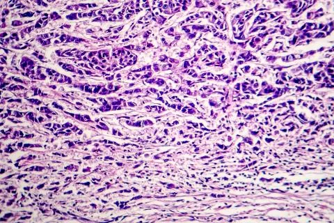 Lymph node cancer Stock Photos
