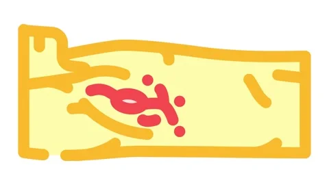 Lymph node dissection surgery color icon animation Stock Footage 327261626