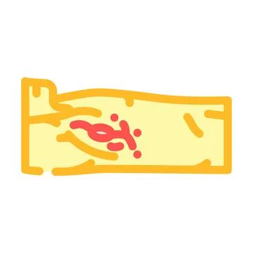 Lymph node dissection surgery color icon vector illustration Illustrazione stock