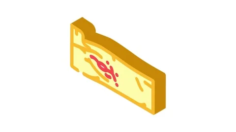 Lymph node dissection surgery isometric icon animation Stock Footage 327283007