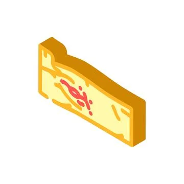 Lymph node dissection surgery isometric icon vector illustration Stock Illustration