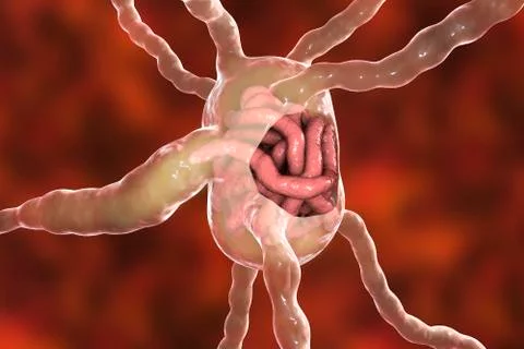 Lymph node with filaria worms, concept of elephantiasis, or lymphatic filaria Stock Illustration
