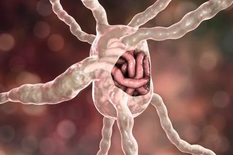 Lymph node with filaria worms, concept of elephantiasis, or lymphatic filaria Stock Illustration