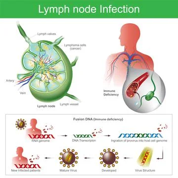 Lymph node Infection. Stock Illustration
