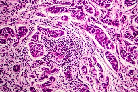 Lymph node metastasis Stock Photos