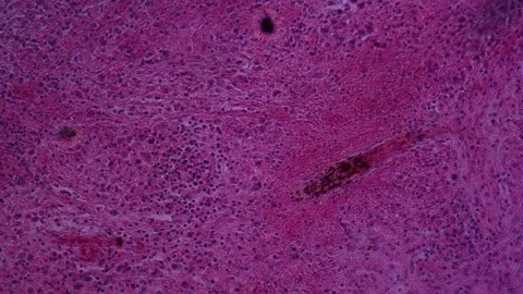 Lymph node sarcoma tissue 200x Stock-Footage 342835001
