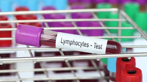 Lymphocytes test, blood sample to analyze in the laboratory Stock Footage 239625448