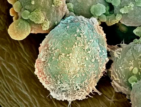 Lymphoma lymph cell, sem 스톡 사진