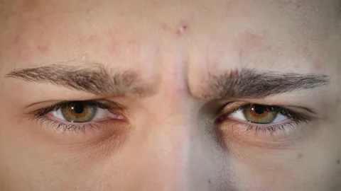 Macro close up of angry man's face with hazel eyes and acne skin condition. Stock Footage 167524518