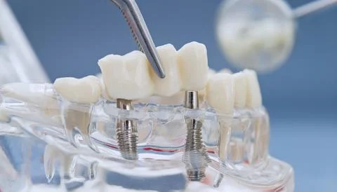 Macro close-up of artificial teeth installation. Dentist tool placing ceramic Фото