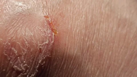 Macro Close Up Of Extremely Dry Cracked And Peeling Human Skin With Small Wound Video stock 346952395