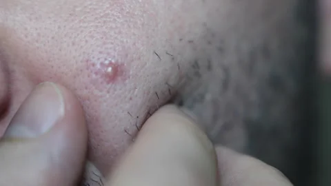 Macro close-up of fingers squeezing a small pimple on facial skin with short Stock Footage 327752919