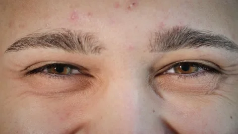 Macro close up of happy man's face smiling with beautiful hazel eye and pimples. Stock Footage 167525289