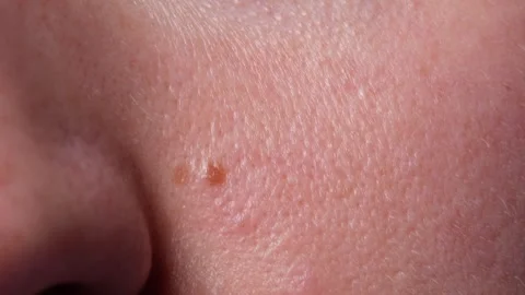 Macro Close-Up of Human Skin Mole – Dermatology and Medical Research Concept Video stock 313442494