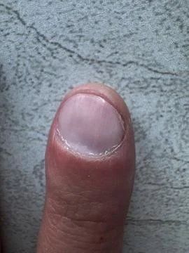 Macro close-up of human thumb with natural unpolished nail and dry cuticles.. Stock Photos