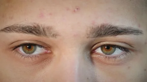 Macro close up of man's face with hazel eyes and acne pimples looking around. Stock Footage 167524758