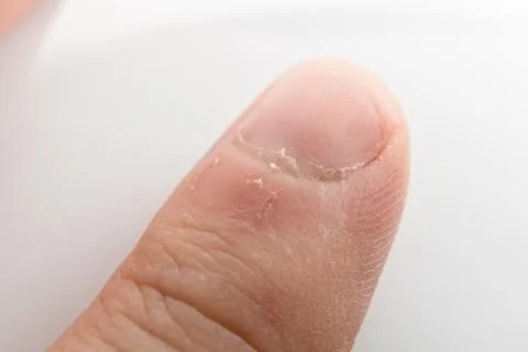 Macro close-up of a man's thumb with hangnail and dry cuticle damage isolated on Stock Photos