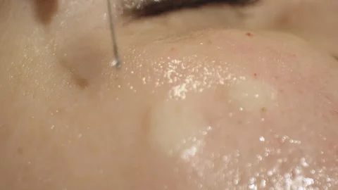 Macro Close-Up of Skin Injection Stock Footage 317495817