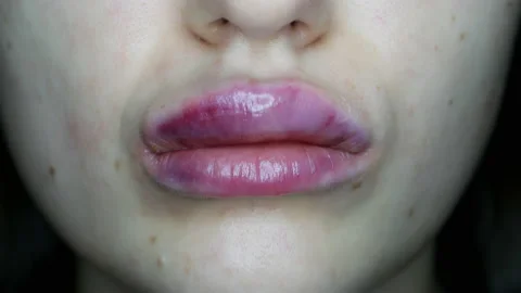 Macro close-up of swollen lips after injections of hyaluron, lip augmentation Stock Footage 131403531
