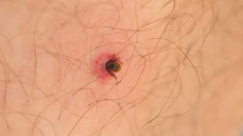 Macro close-up of a tick embedded in a person's skin after it has burrowed 스톡 동영상 113845477