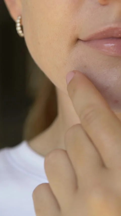 Macro close-up of woman using hydrocolloid pimple patch on irritated skin Stock Footage 336408004