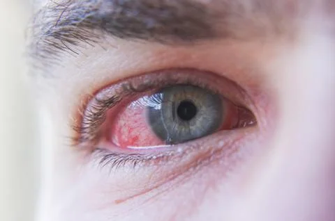 Macro closeup of  conjunctivitis infeced red eye Stock Photos